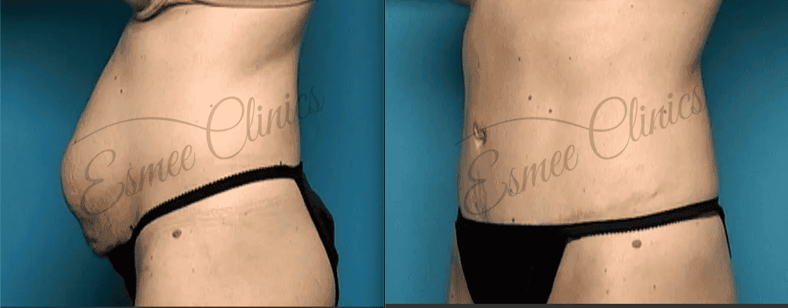 Before and After img